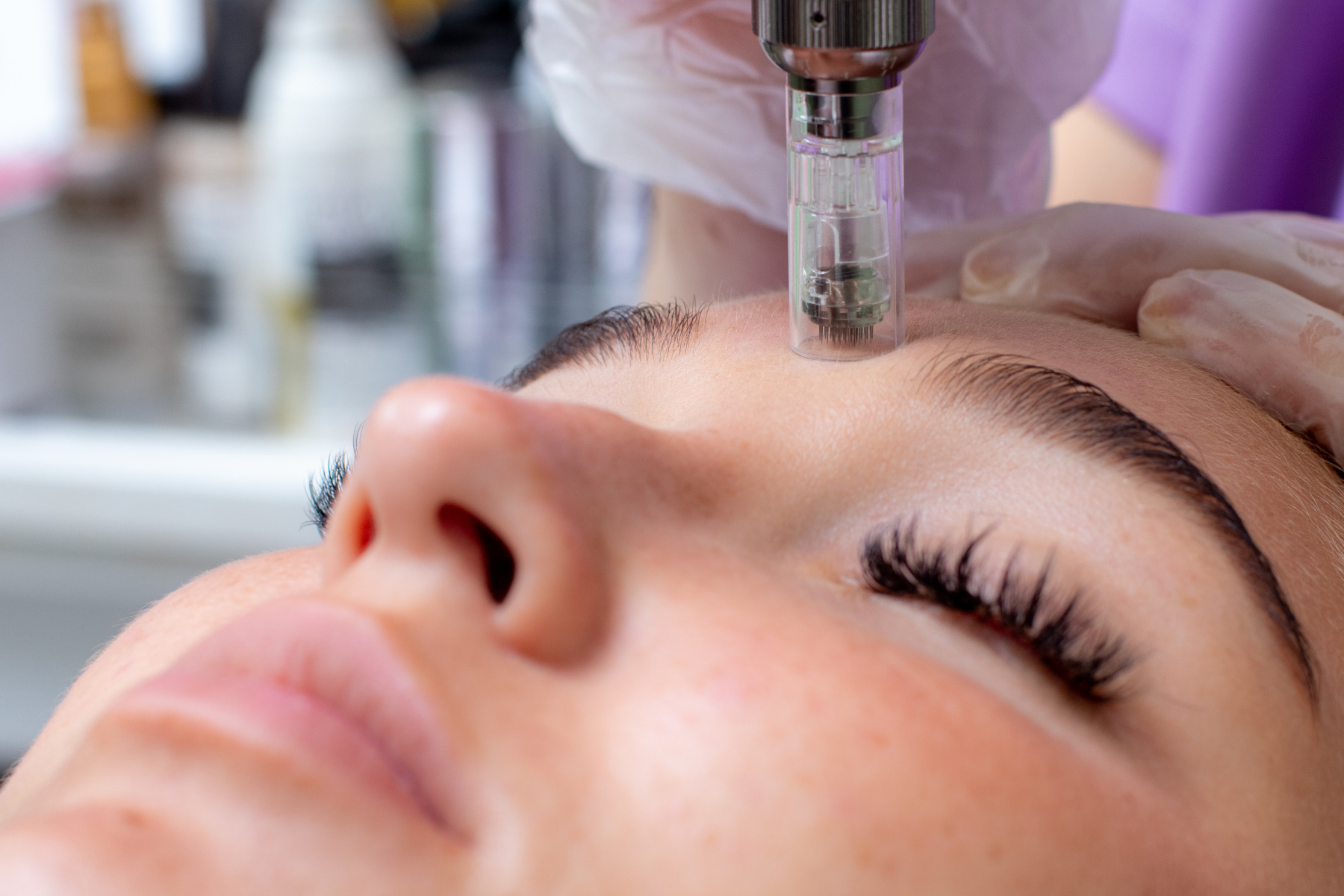 MICRO NEEDLING